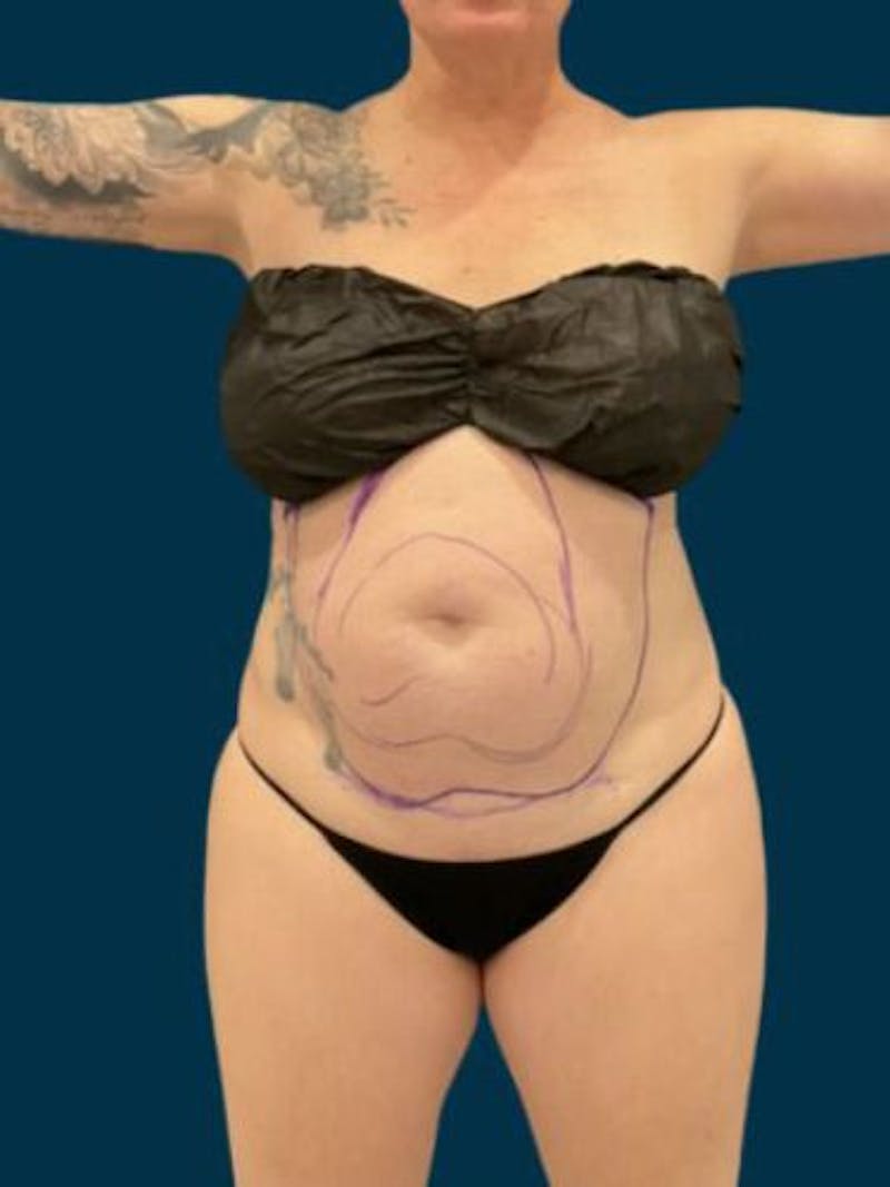 Liposuction Before & After Gallery - Patient 370256 - Image 3