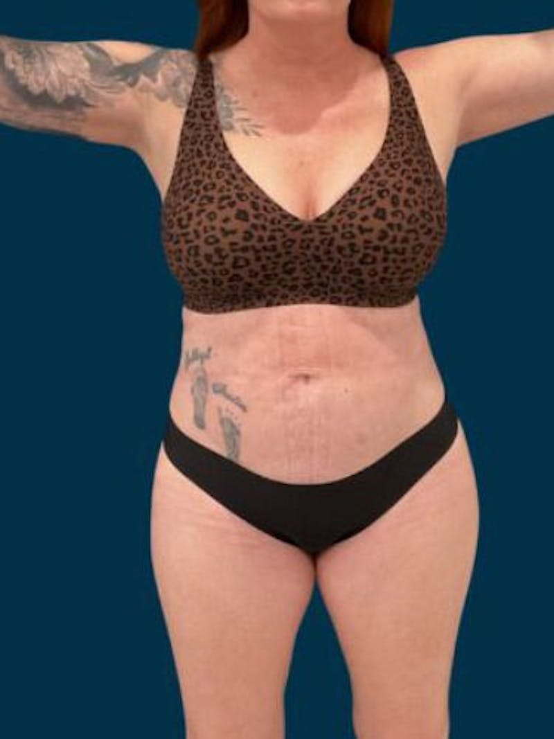 Liposuction Before & After Gallery - Patient 370256 - Image 4