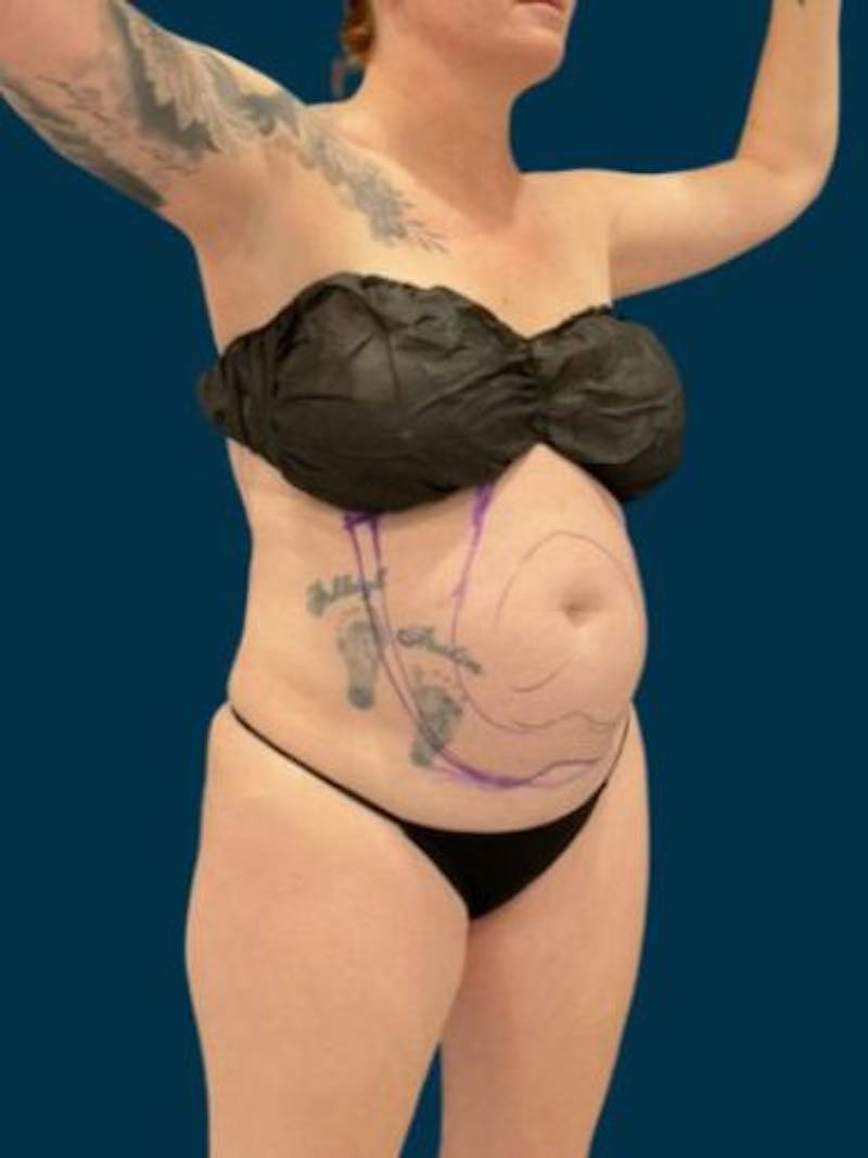 Liposuction Before & After Gallery - Patient 370256 - Image 5