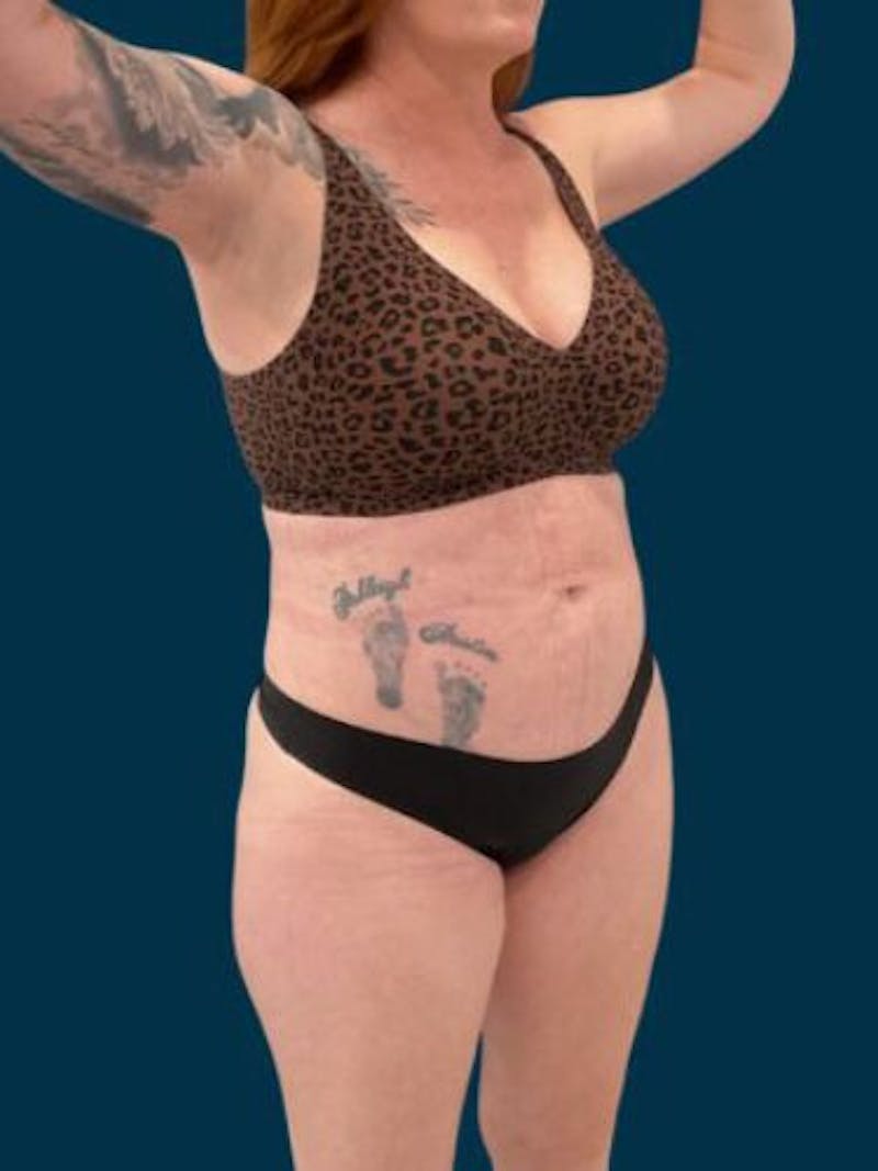 Liposuction Before & After Gallery - Patient 370256 - Image 6