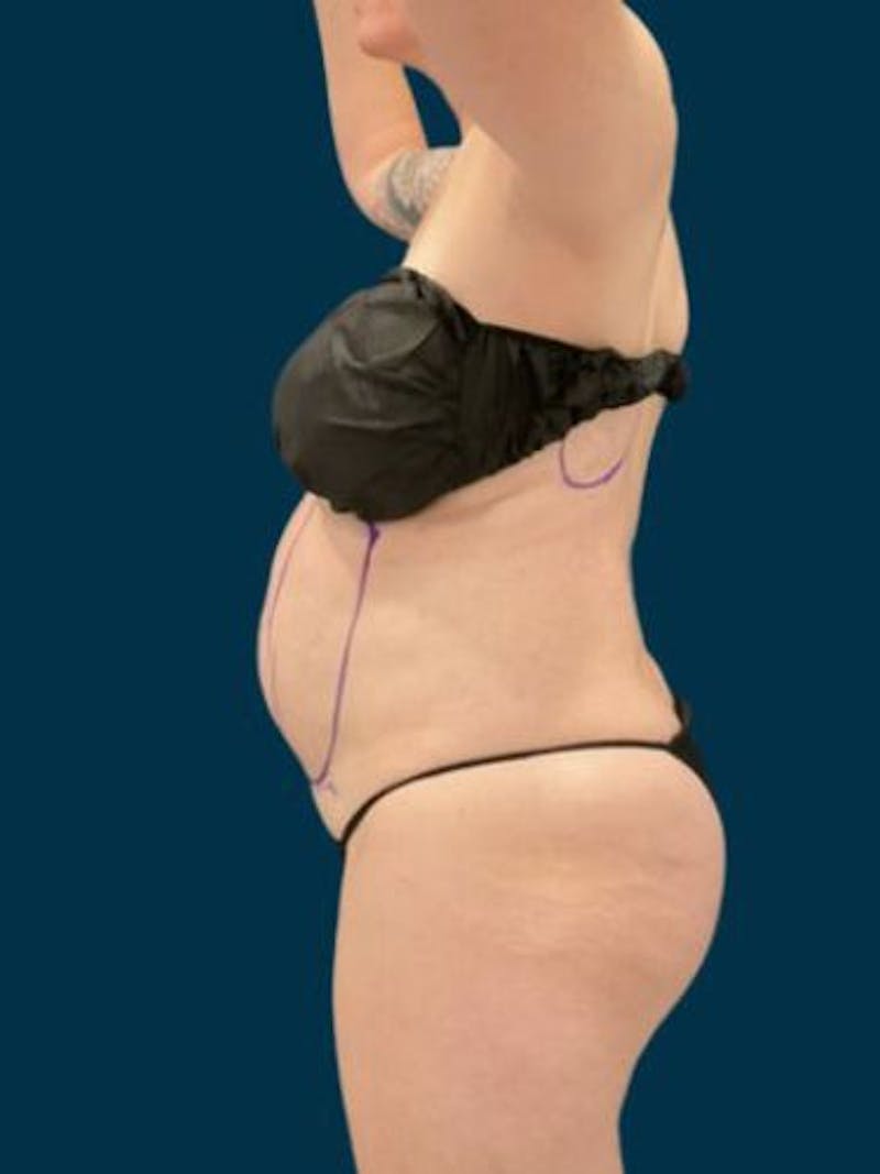 Liposuction Before & After Gallery - Patient 370256 - Image 7