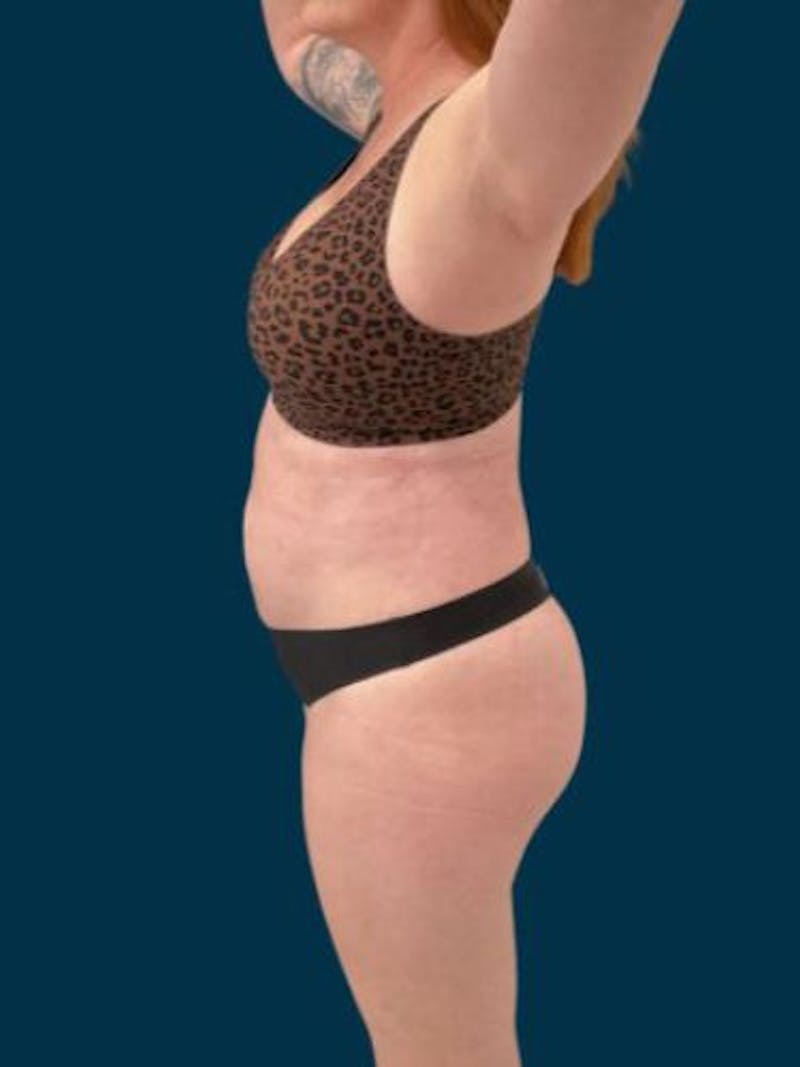 Liposuction Before & After Gallery - Patient 370256 - Image 8