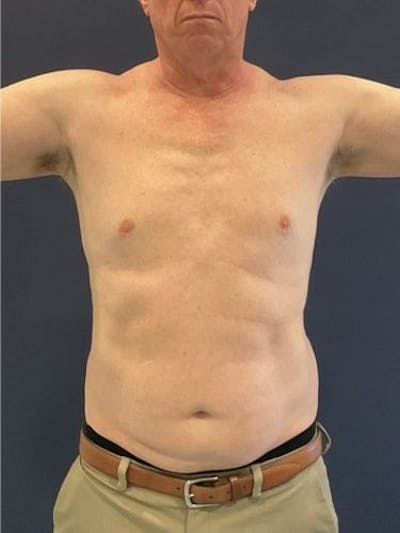 Liposuction Before & After Gallery - Patient 321331 - Image 1