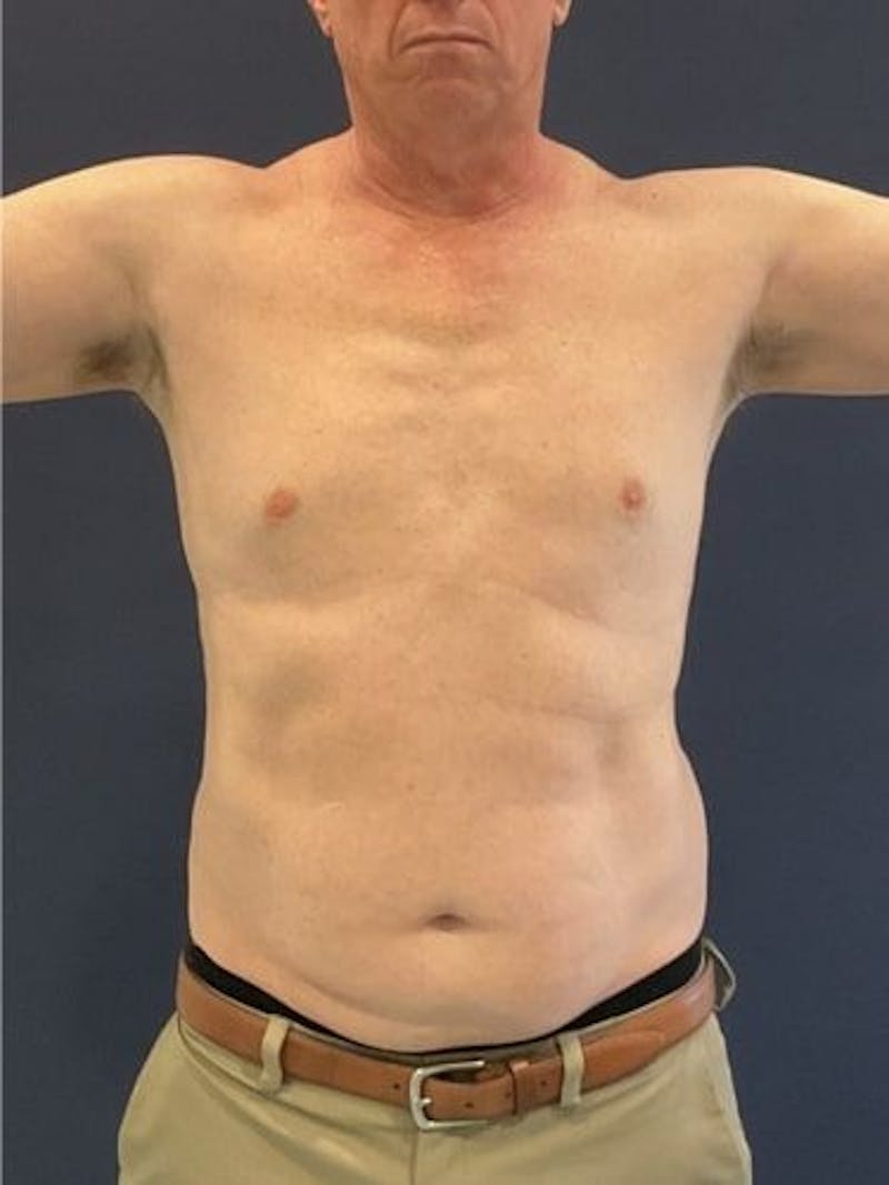 Liposuction Before & After Gallery - Patient 321331 - Image 1