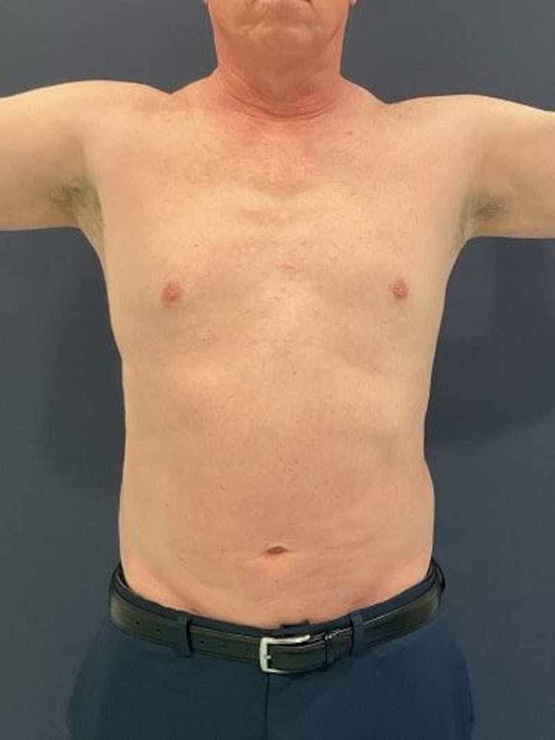 Liposuction Before & After Gallery - Patient 321331 - Image 2