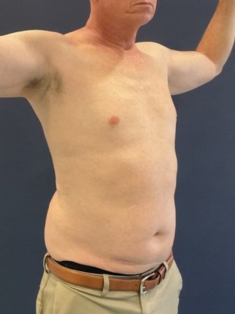 Liposuction Before & After Gallery - Patient 321331 - Image 3