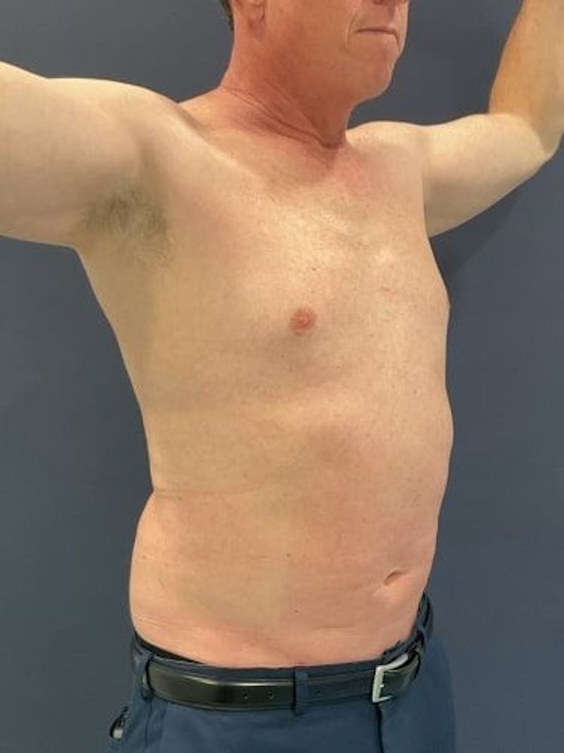 Liposuction Before & After Gallery - Patient 321331 - Image 4