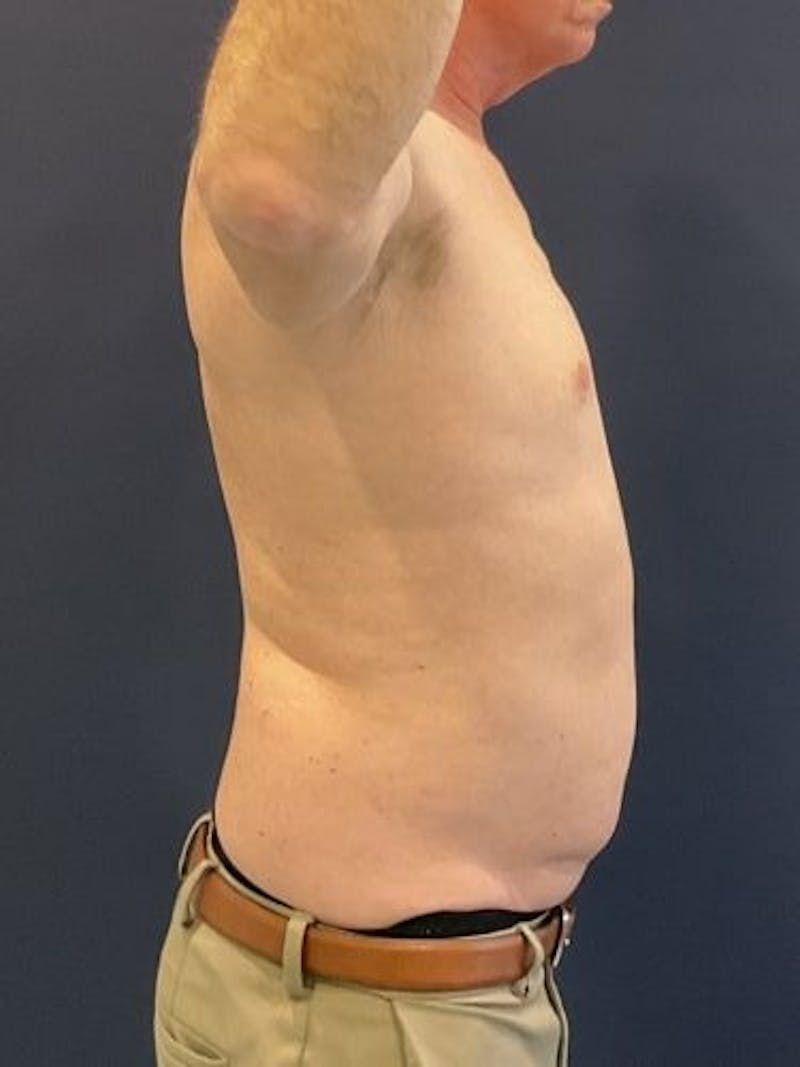 Liposuction Before & After Gallery - Patient 321331 - Image 5