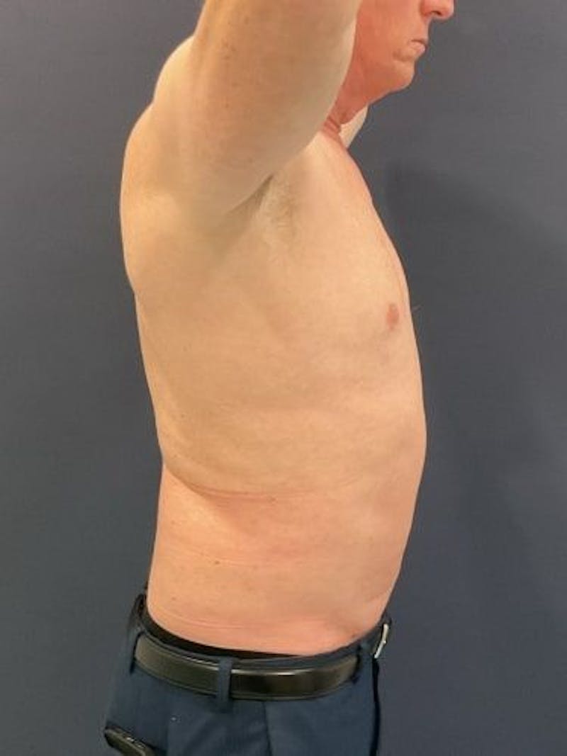 Liposuction Before & After Gallery - Patient 321331 - Image 6