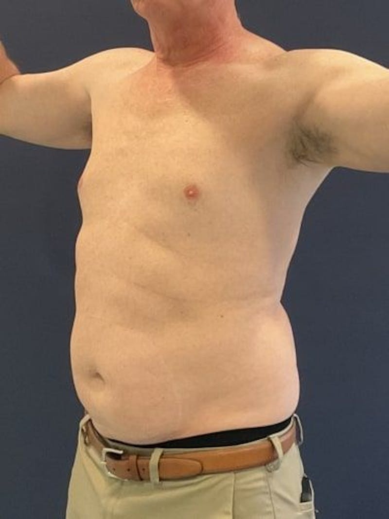 Liposuction Before & After Gallery - Patient 321331 - Image 7