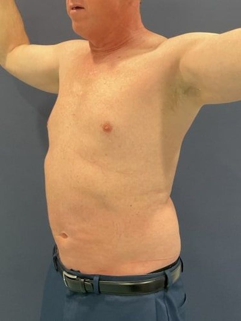 Liposuction Before & After Gallery - Patient 321331 - Image 8