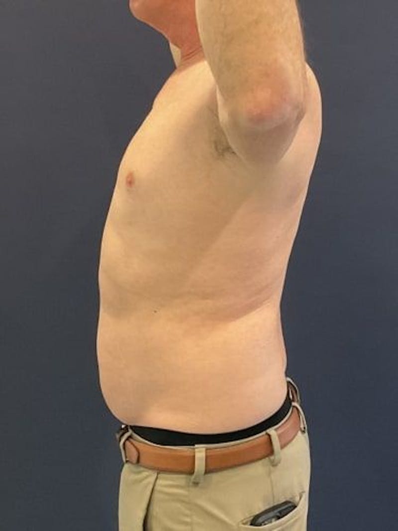 Liposuction Before & After Gallery - Patient 321331 - Image 9