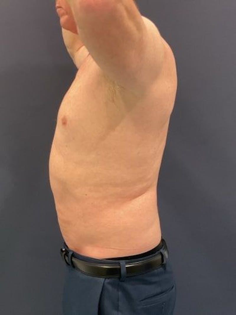 Liposuction Before & After Gallery - Patient 321331 - Image 10
