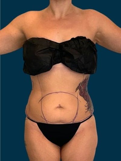 Liposuction Before & After Gallery - Patient 309437 - Image 1
