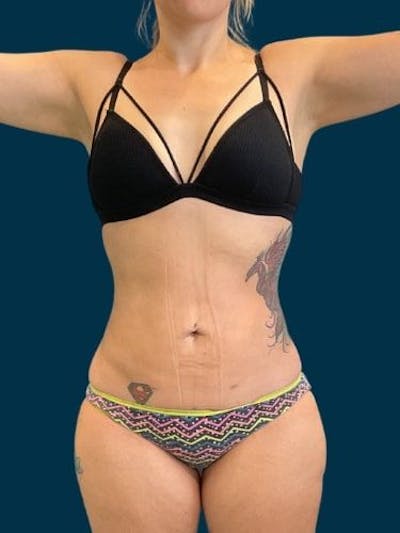 Liposuction Before & After Gallery - Patient 309437 - Image 2