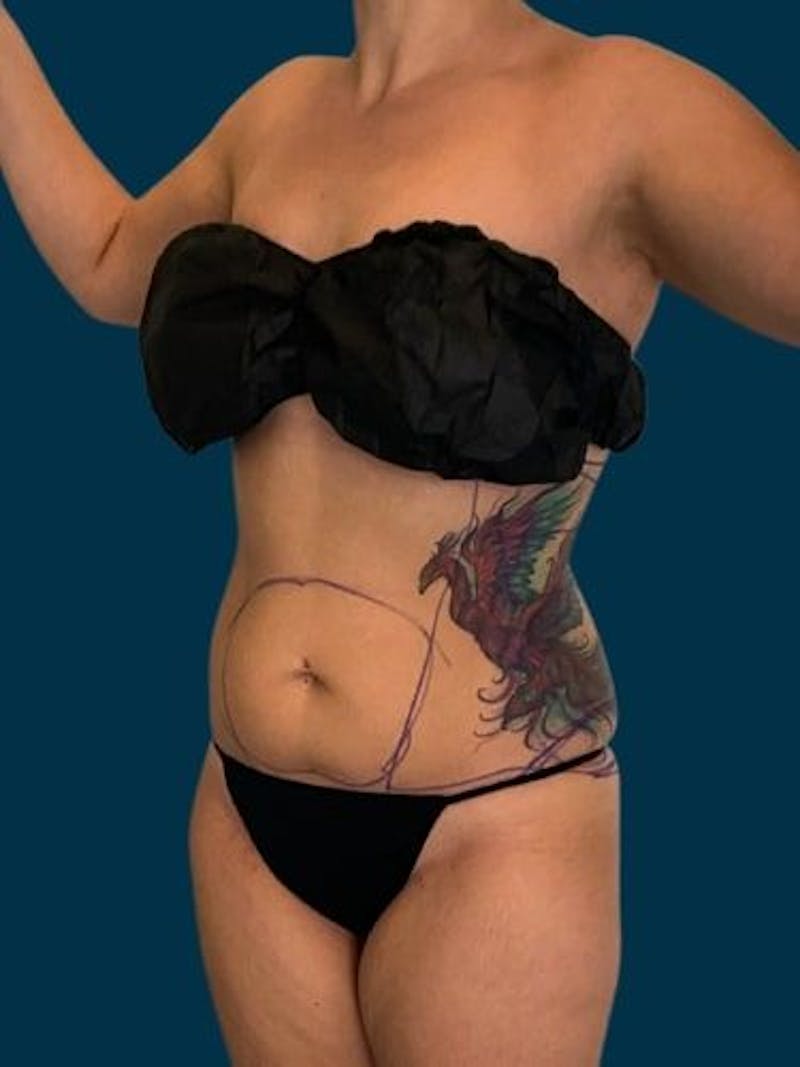 Liposuction Before & After Gallery - Patient 309437 - Image 3