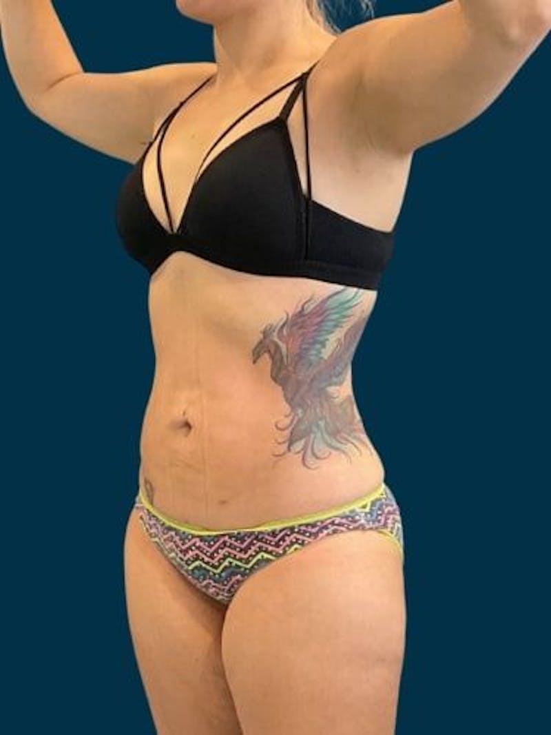 Liposuction Before & After Gallery - Patient 309437 - Image 4