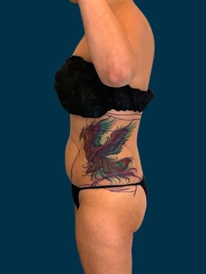 Liposuction Before & After Gallery - Patient 309437 - Image 5