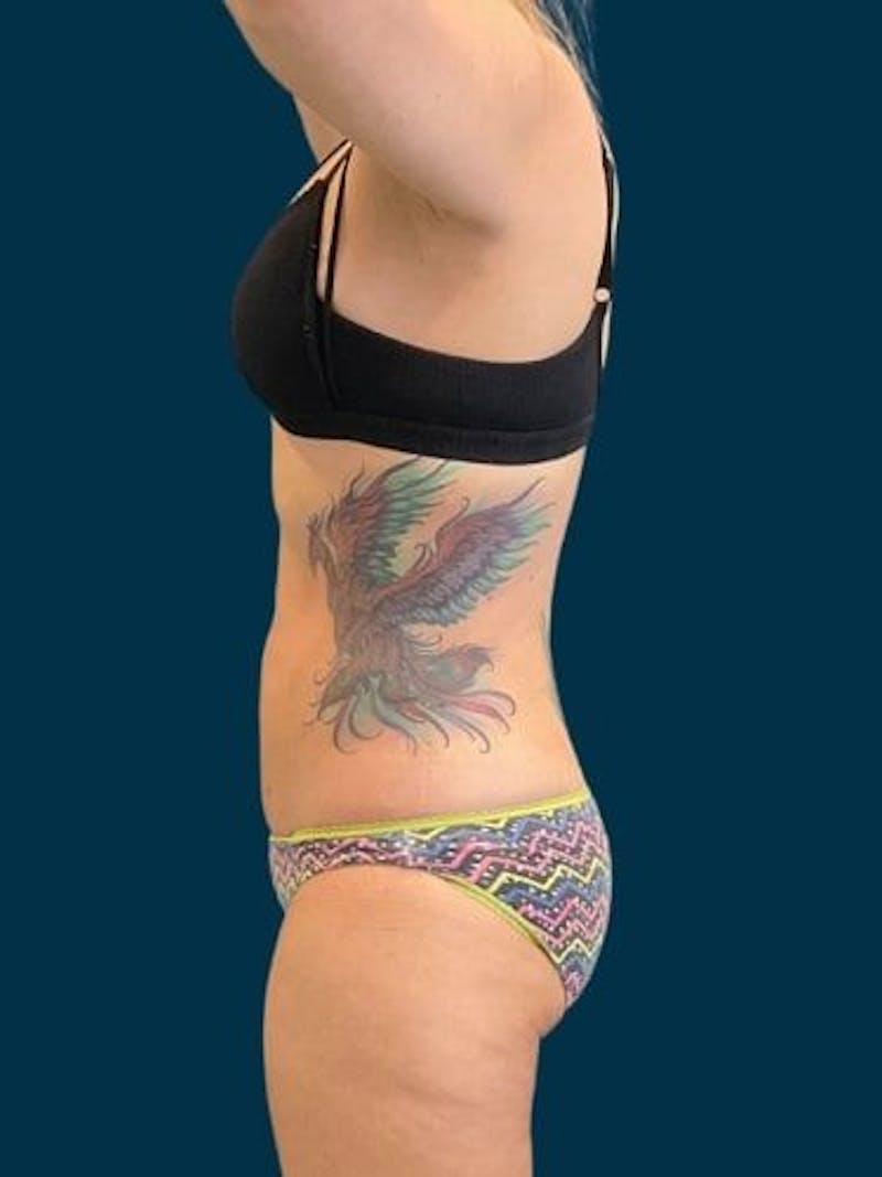 Liposuction Before & After Gallery - Patient 309437 - Image 6