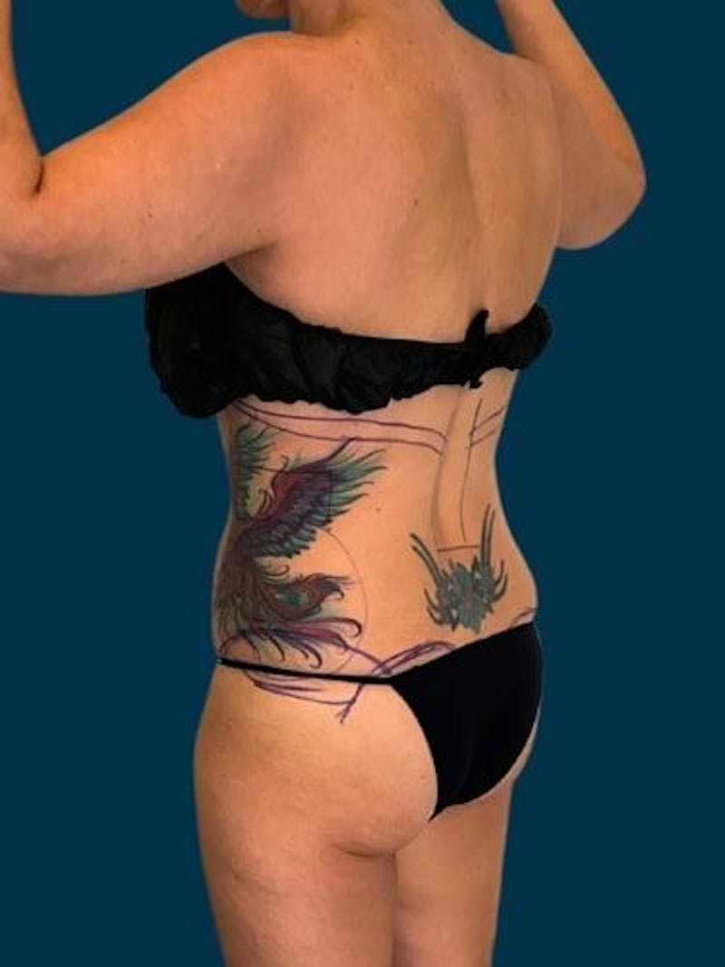 Liposuction Before & After Gallery - Patient 309437 - Image 7