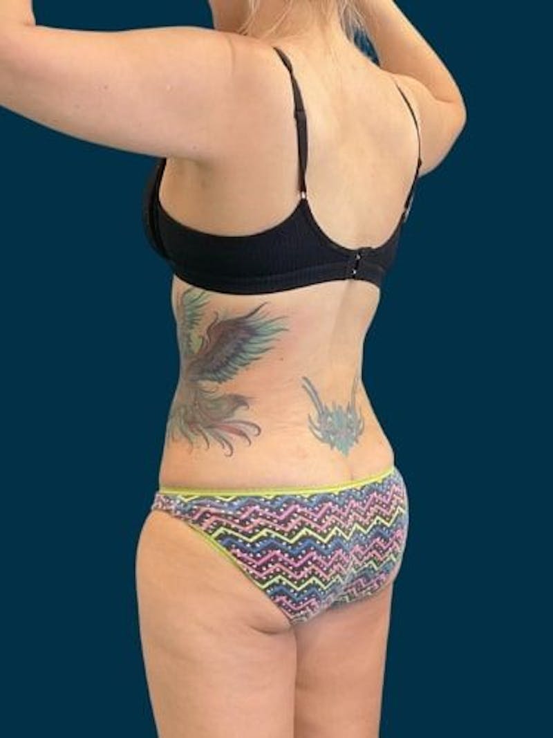 Liposuction Before & After Gallery - Patient 309437 - Image 8