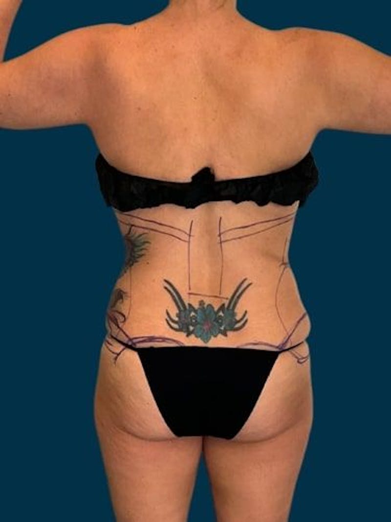 Liposuction Before & After Gallery - Patient 309437 - Image 9