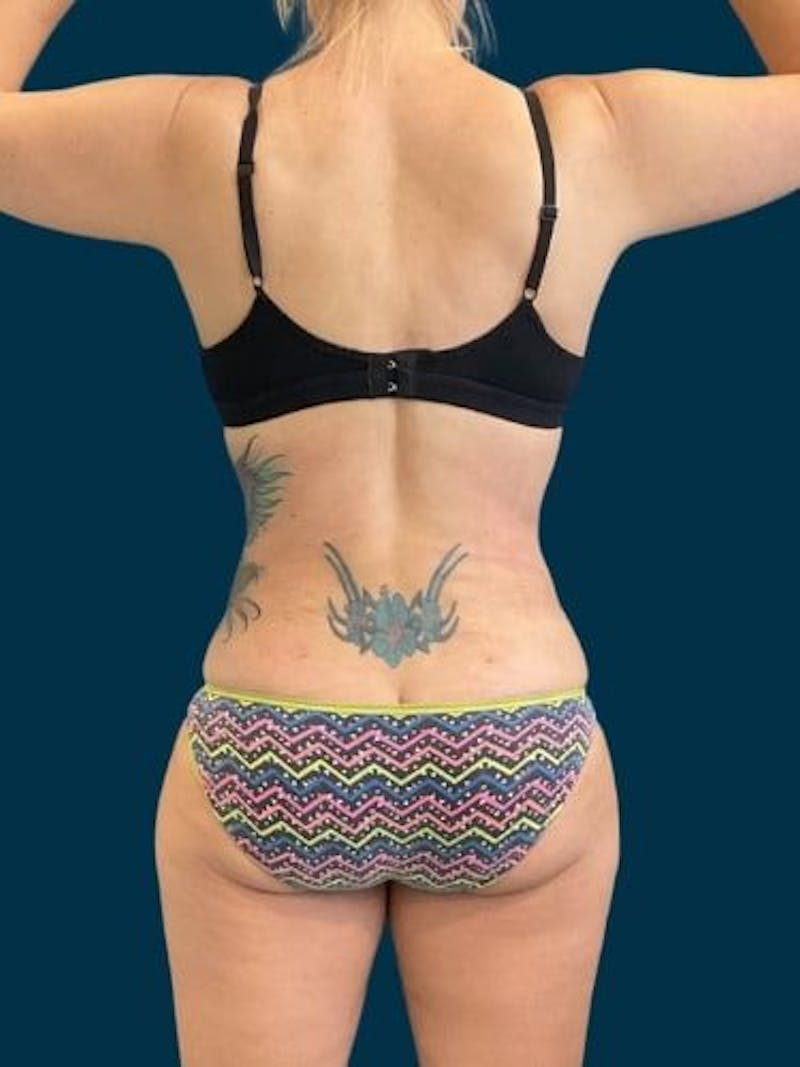 Liposuction Before & After Gallery - Patient 309437 - Image 10