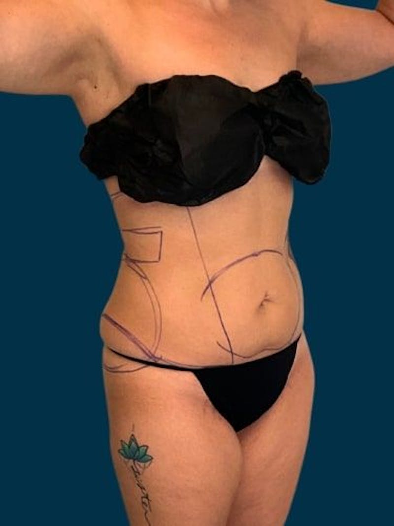 Liposuction Before & After Gallery - Patient 309437 - Image 11