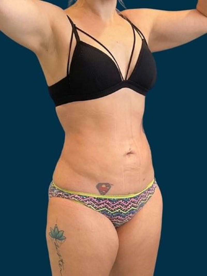 Liposuction Before & After Gallery - Patient 309437 - Image 12
