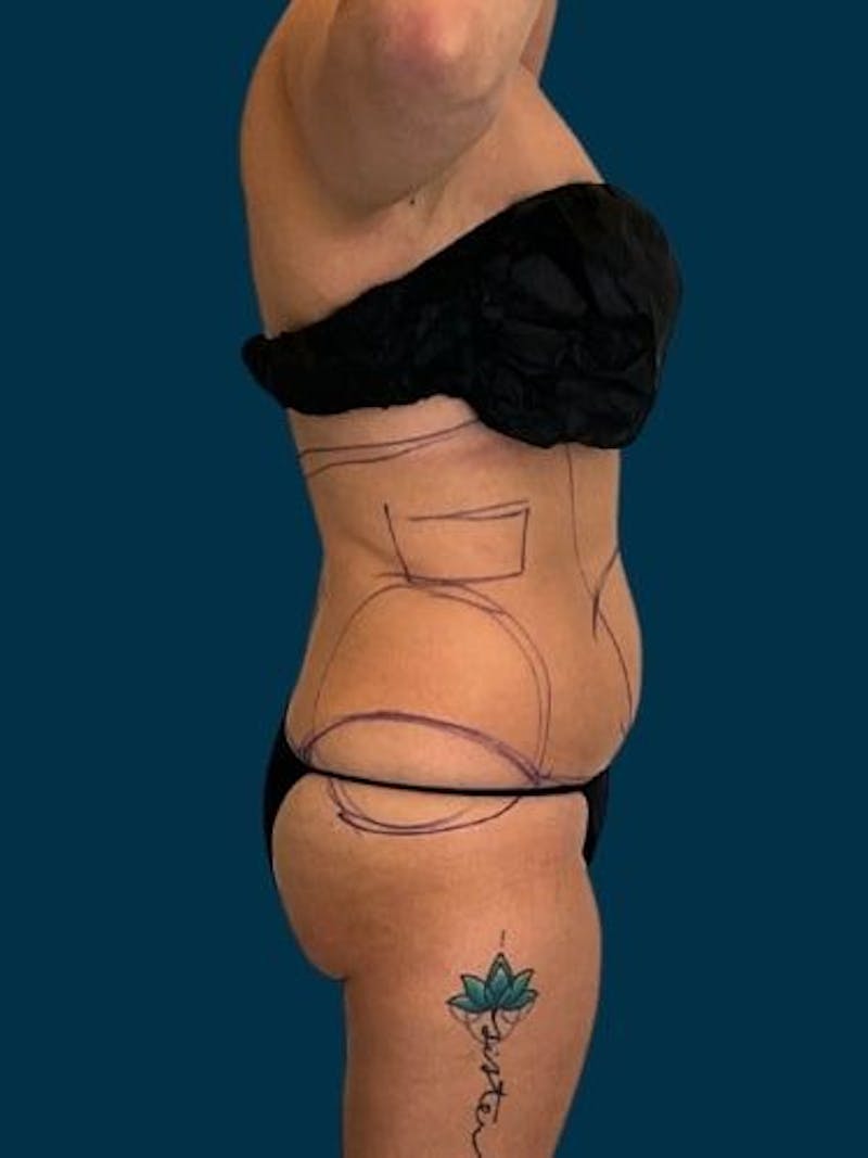 Liposuction Before & After Gallery - Patient 309437 - Image 13