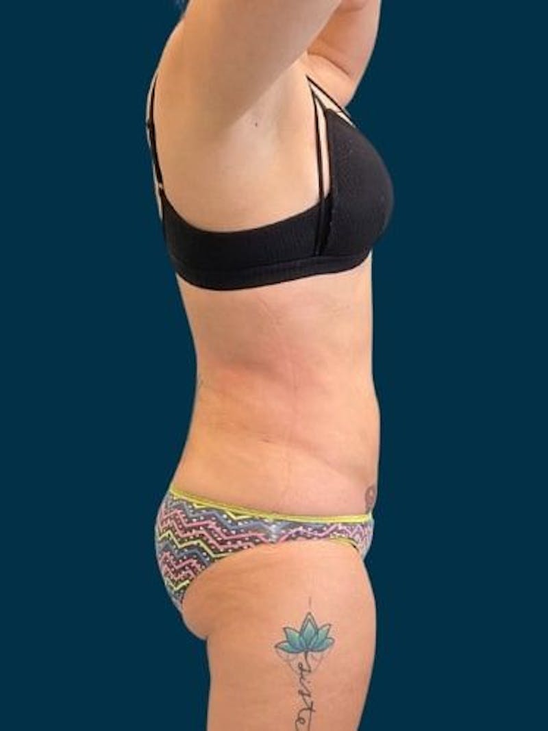 Liposuction Before & After Gallery - Patient 309437 - Image 14
