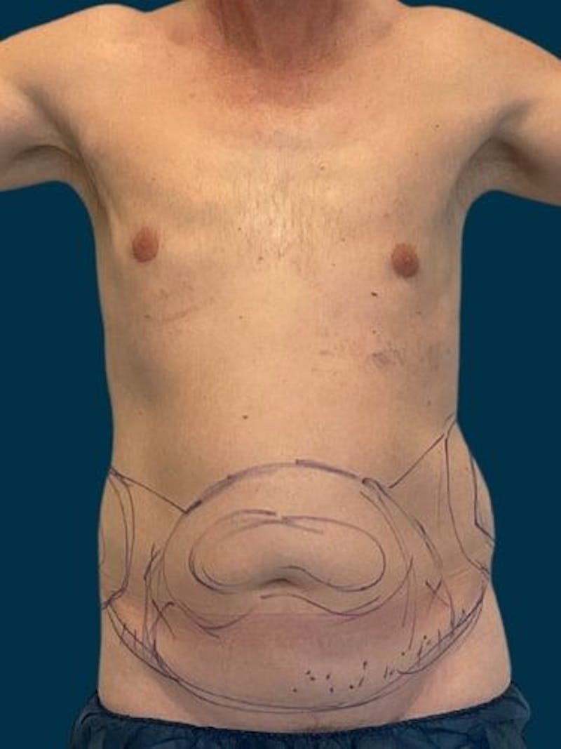 Liposuction Before & After Gallery - Patient 405152 - Image 1