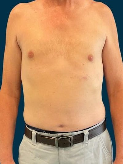 Liposuction Before & After Gallery - Patient 405152 - Image 2