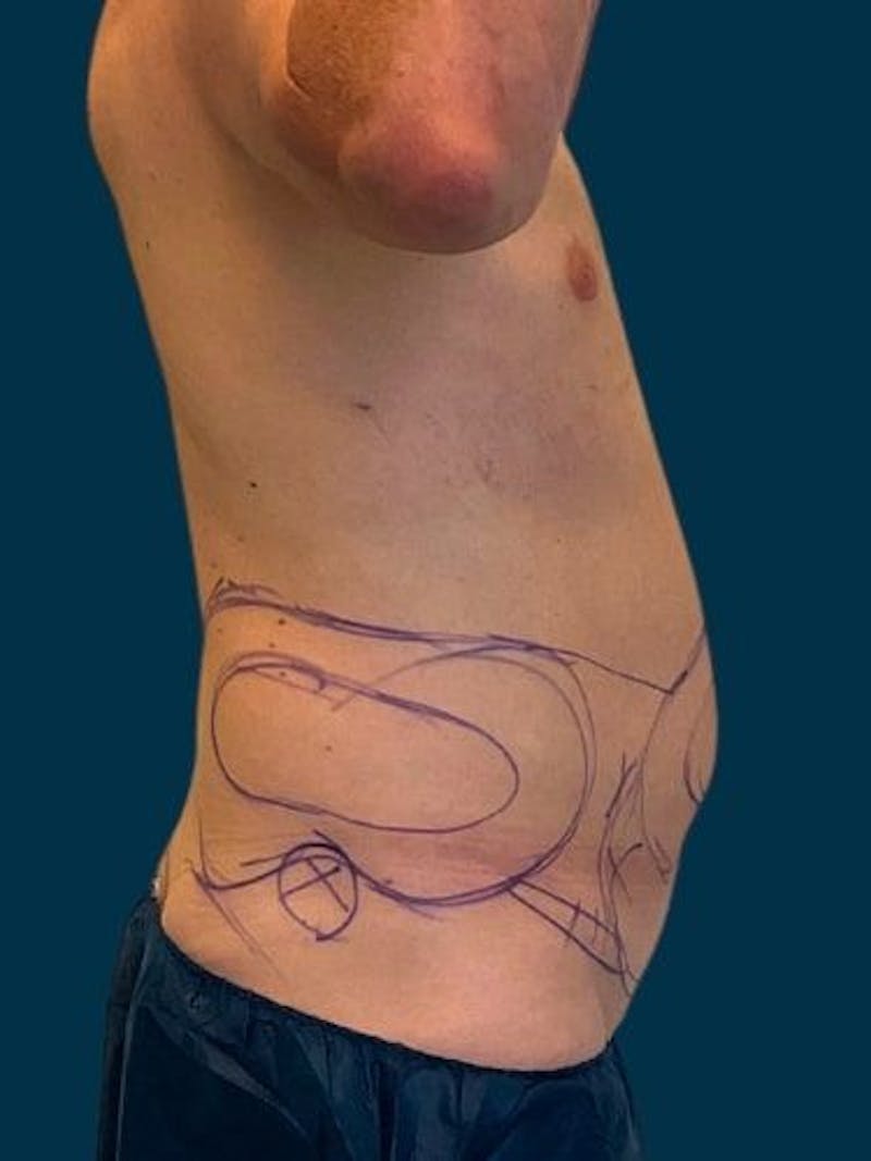 Liposuction Before & After Gallery - Patient 405152 - Image 3