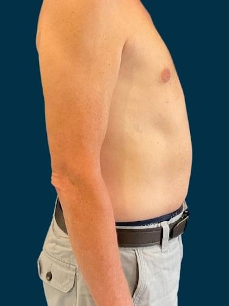 Liposuction Before & After Gallery - Patient 405152 - Image 4