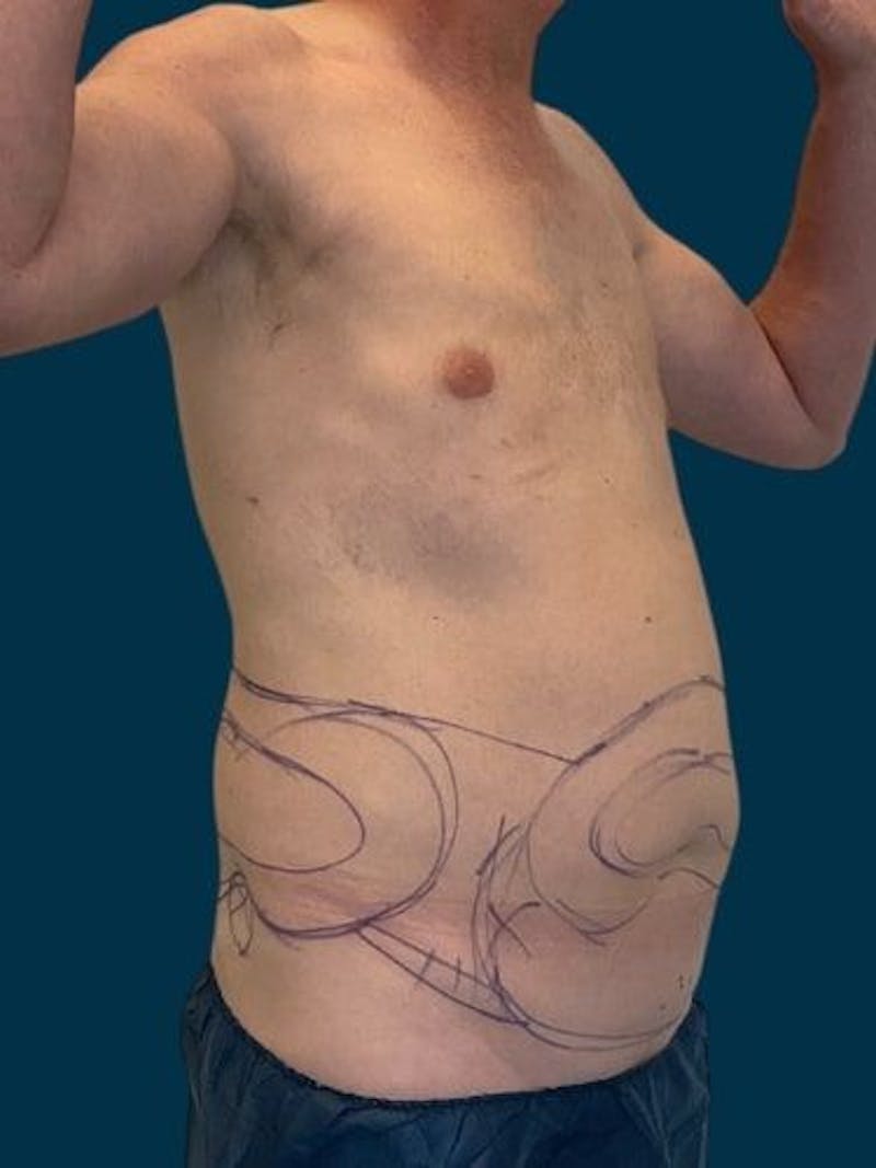 Liposuction Before & After Gallery - Patient 405152 - Image 5