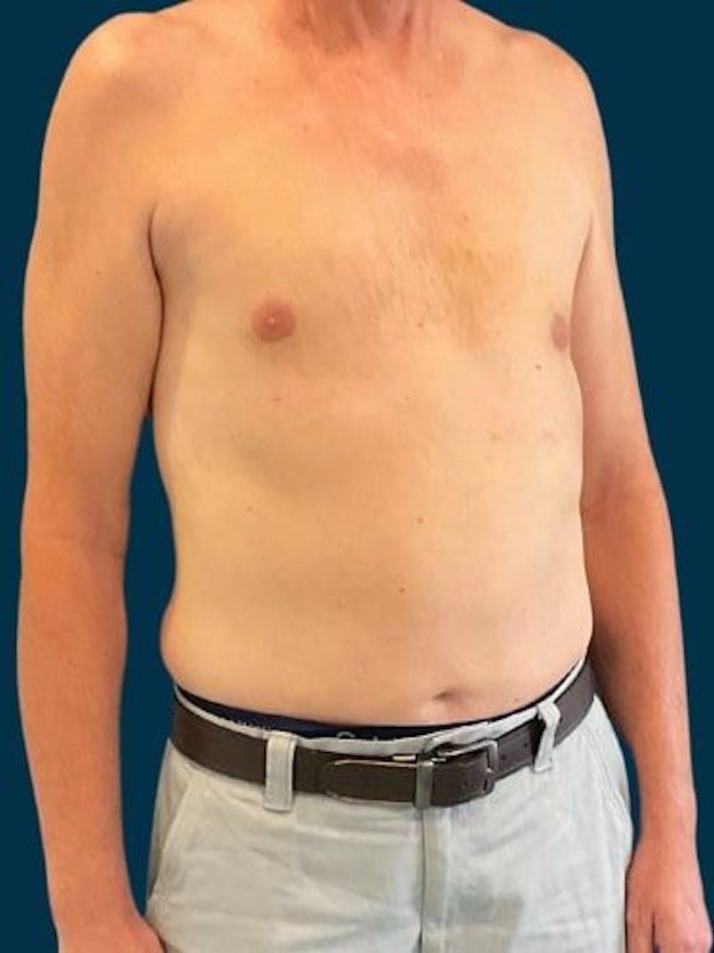 Liposuction Before & After Gallery - Patient 405152 - Image 6
