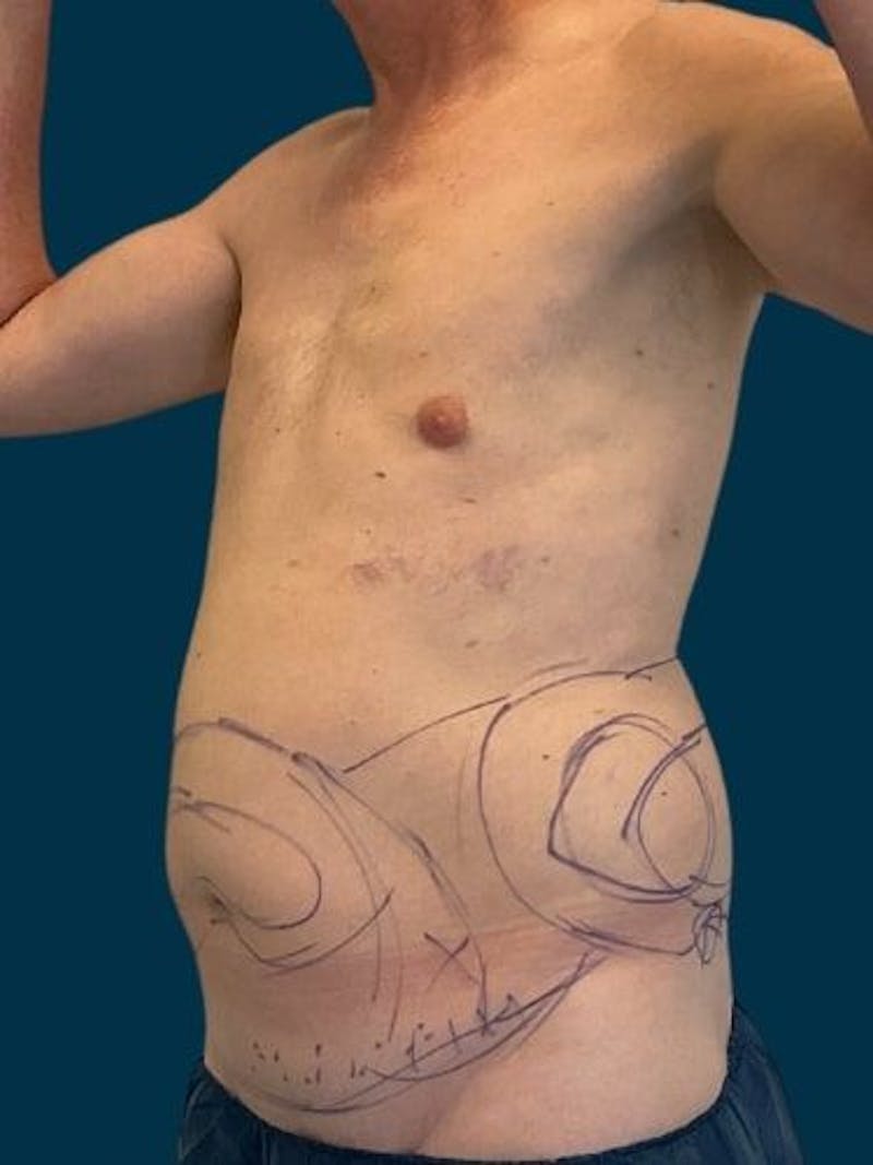 Liposuction Before & After Gallery - Patient 405152 - Image 7