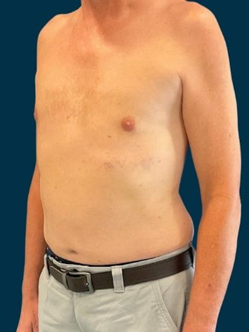 Liposuction Before & After Gallery - Patient 405152 - Image 8