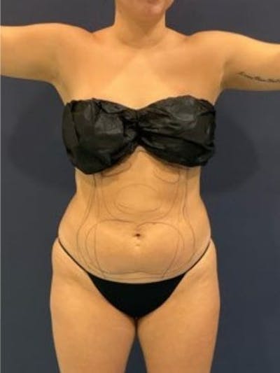 Liposuction Before & After Gallery - Patient 195224 - Image 1