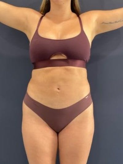 Liposuction Before & After Gallery - Patient 195224 - Image 2