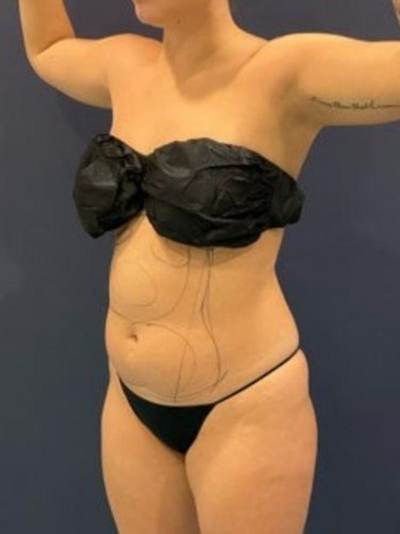 Liposuction Before & After Gallery - Patient 195224 - Image 3