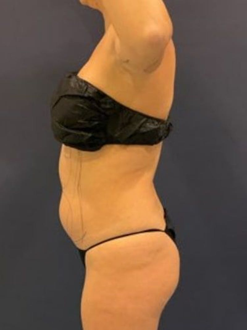 Liposuction Before & After Gallery - Patient 195224 - Image 5