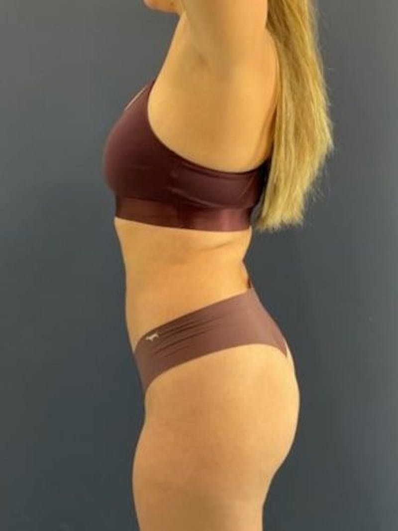 Liposuction Before & After Gallery - Patient 195224 - Image 6