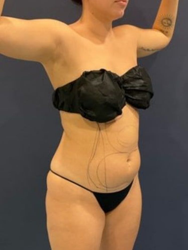 Liposuction Before & After Gallery - Patient 195224 - Image 7