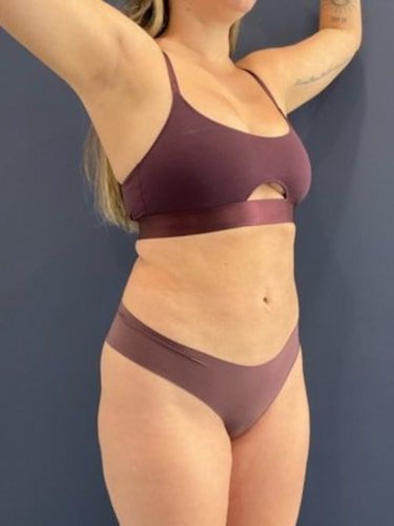 Liposuction Before & After Gallery - Patient 195224 - Image 8