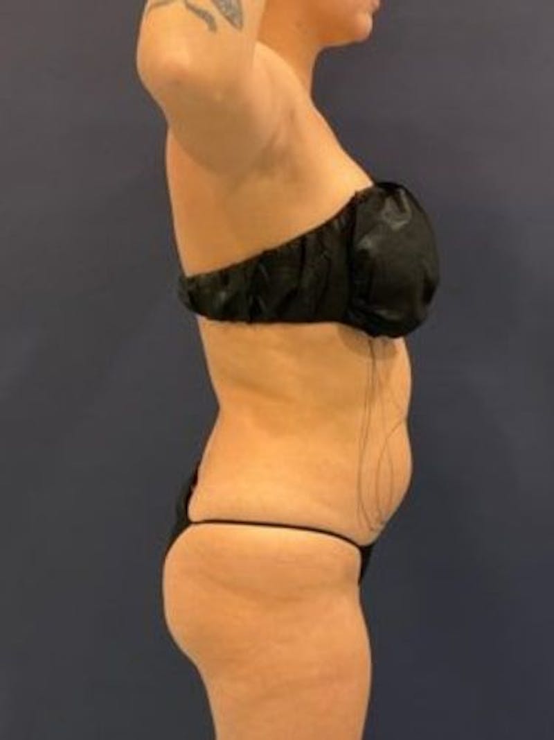 Liposuction Before & After Gallery - Patient 195224 - Image 9