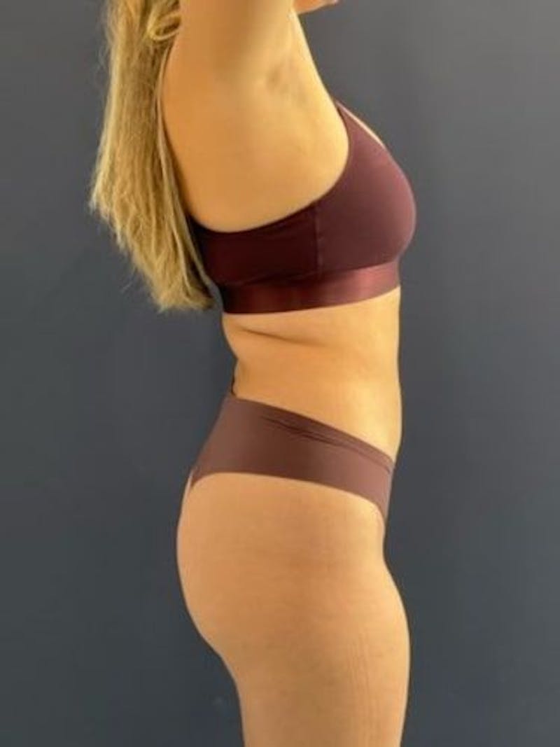 Liposuction Before & After Gallery - Patient 195224 - Image 10