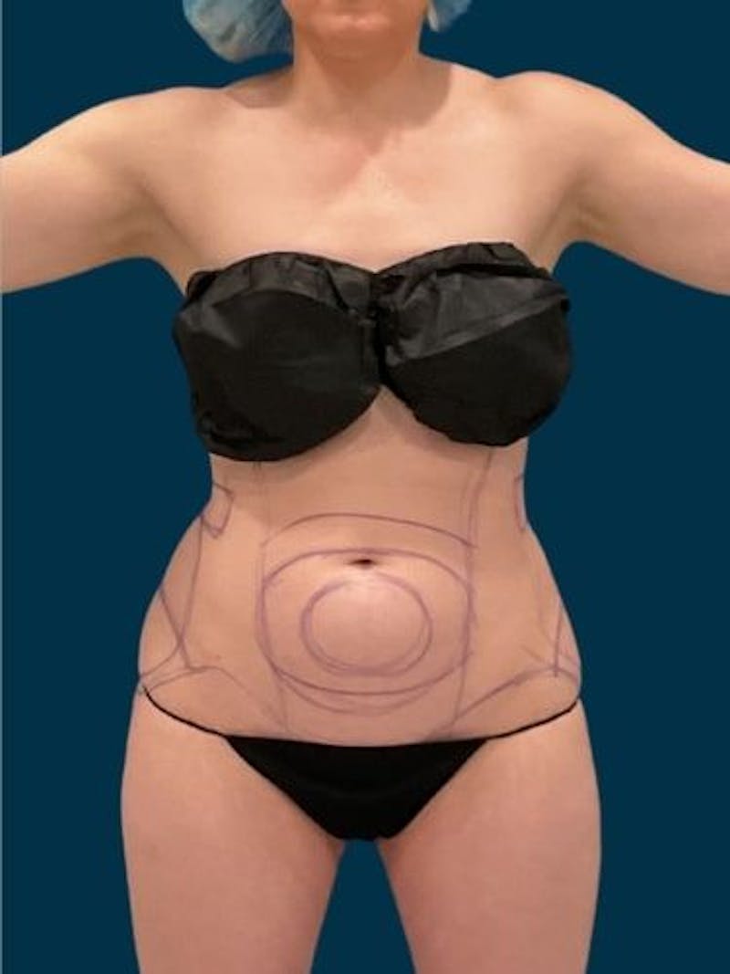 Liposuction Before & After Gallery - Patient 340947 - Image 1