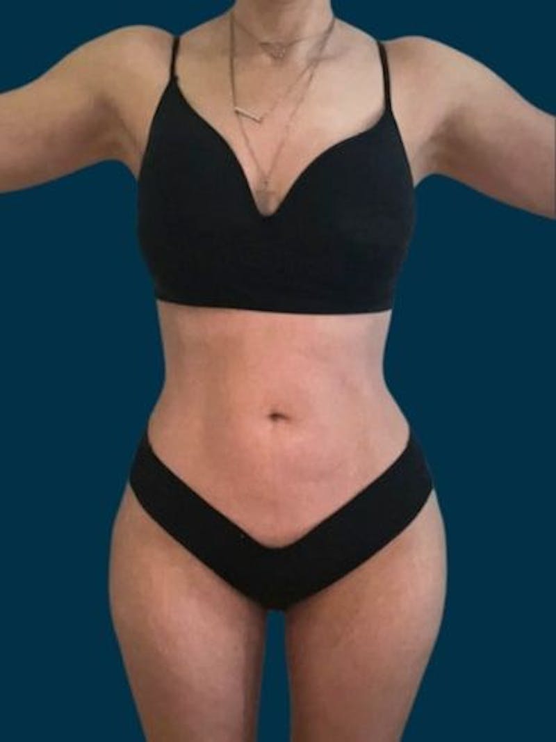 Liposuction Before & After Gallery - Patient 340947 - Image 2